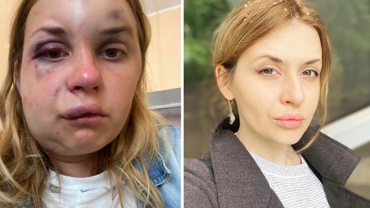 После нападения на журналистку в